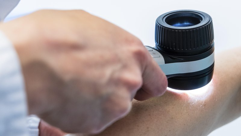Dermatologische Untersuchung mit Dermatoskop an einem Unterarm, Düsseldorf, Deutschland | Bild: picture alliance / imageBROKER | Robert Poorten Dermatologische Untersuchung mit Dermatoskop an einem Unterarm, Düsseldorf, Deutschland
