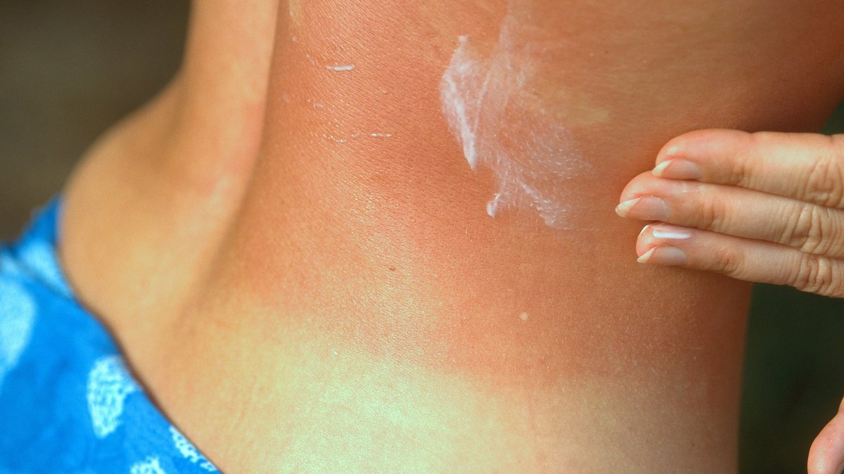Ein geröteter Rücken wird mit Lotion eingecremt