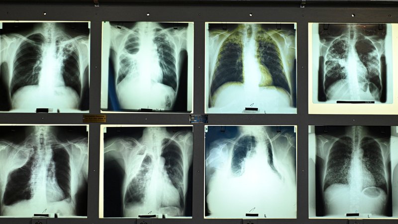 Beschreibung Röntgenbilder von an Tuberkulose Erkrankten in der Bibliothek des Tuberkulose-Archivs (DTA) in Heidelberg.