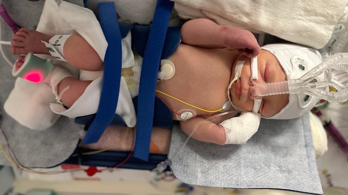Ein Baby auf der Intensivstation. Es leidet an einer Sauerstoffunterversorgung, einer sogenannten Asphyxie, und muss beatmet werden.