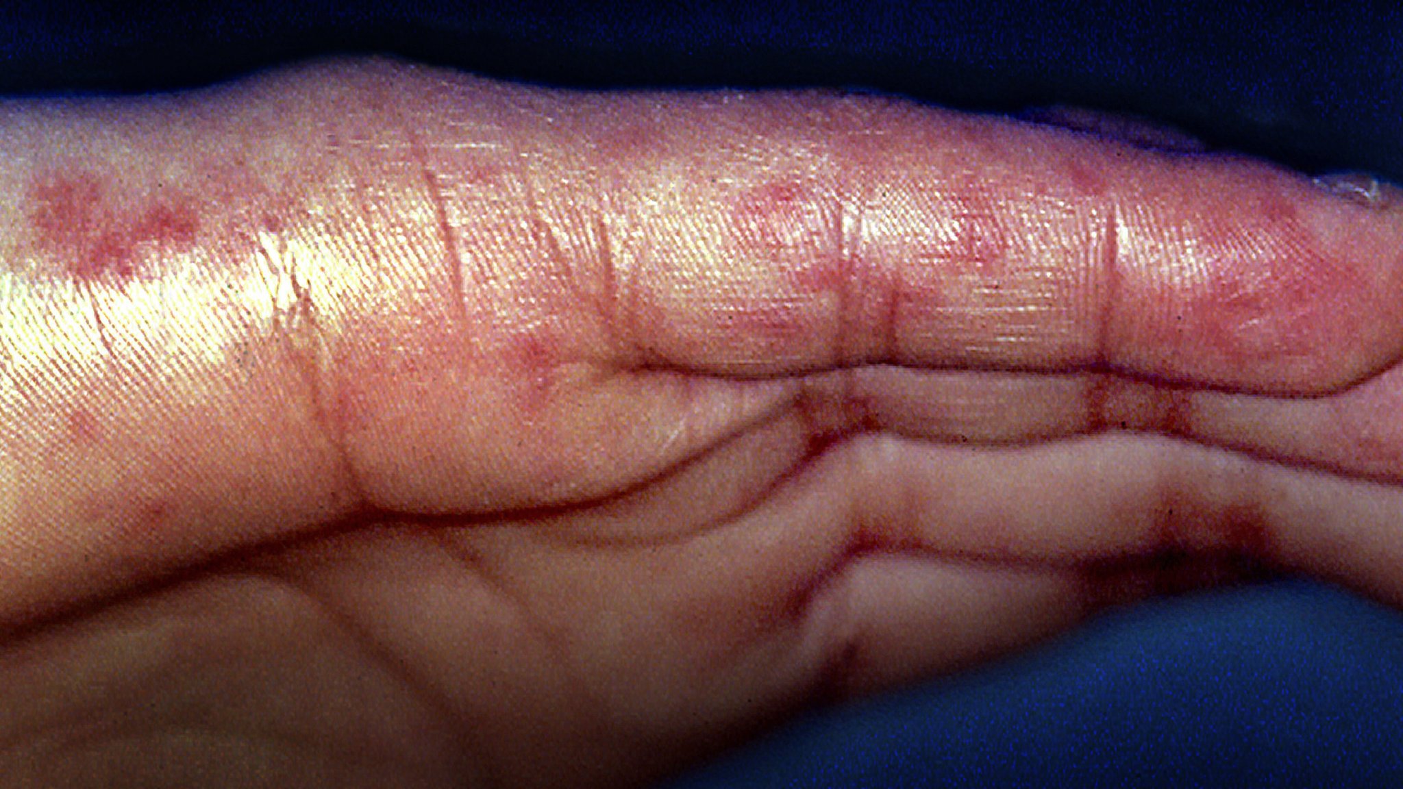 Ein für Lupus typischer Hautausschlag auf einer Hand. | Bild: picture alliance / BSIP | CAVALLINI JAMES Ein für Lupus typischer Hautausschlag auf einer Hand.