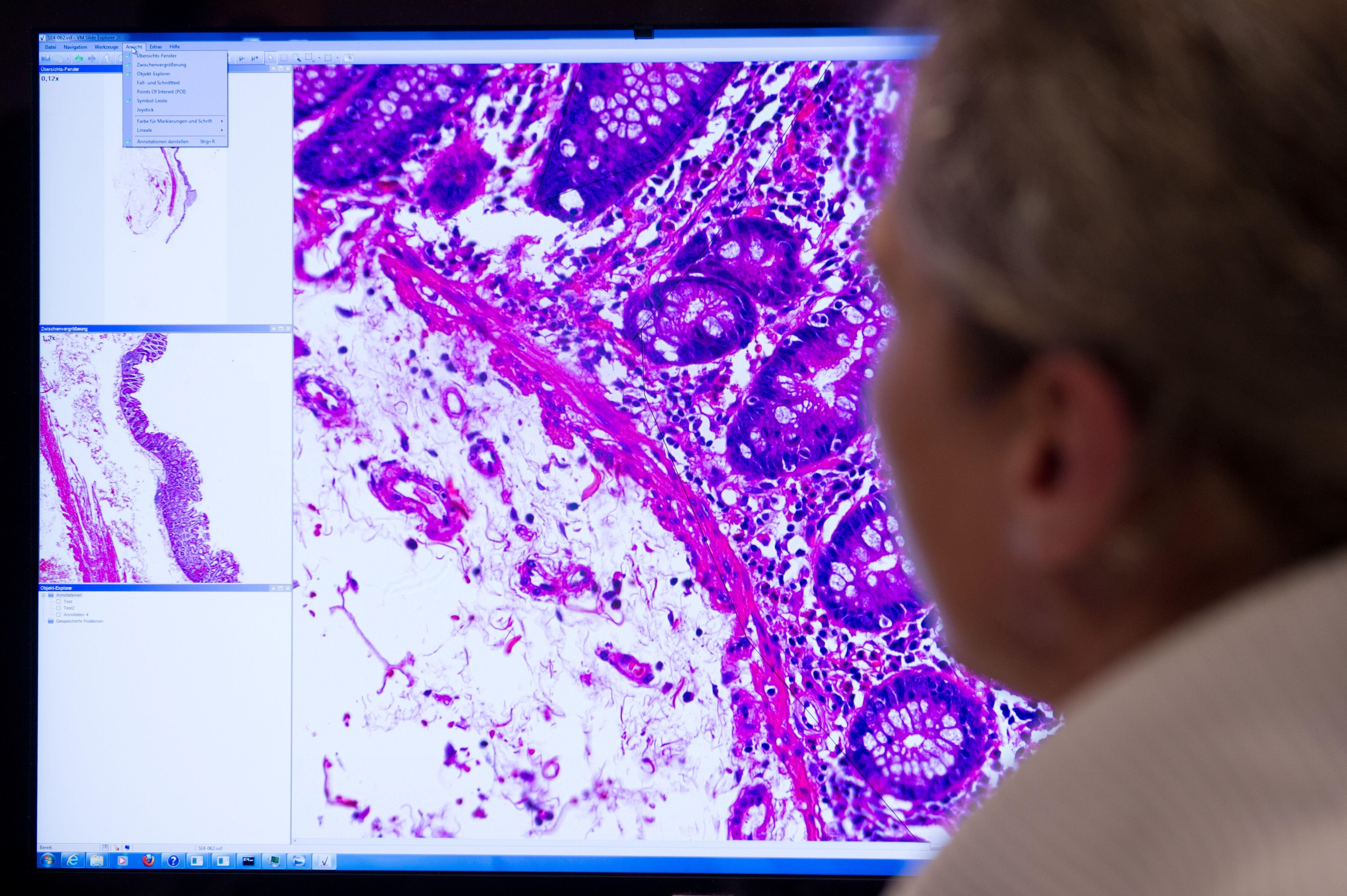 Ein Mitarbeiter der Pathologie an der Charite in Berlin schaut auf ein Monitorbild, das krankhaft verändertes Gewebe zeigt.