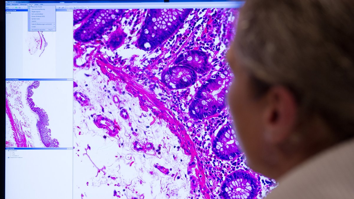 Ein Mitarbeiter der Pathologie an der Charite in Berlin schaut auf ein Monitorbild, das krankhaft verändertes Gewebe zeigt.