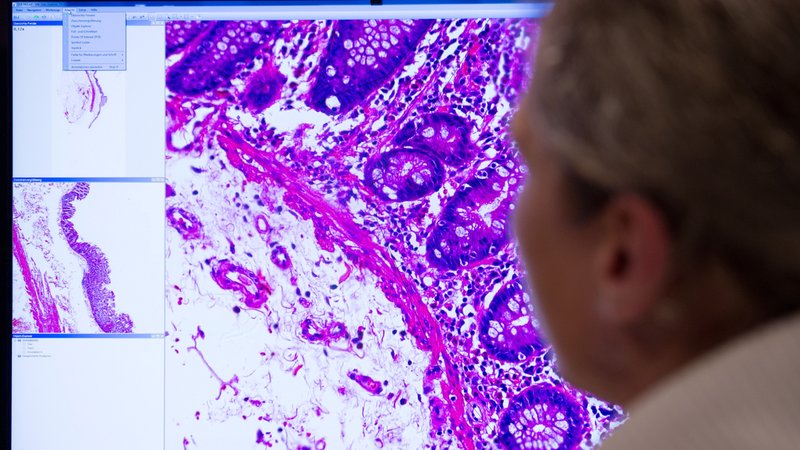 Ein Mitarbeiter der Pathologie an der Charite in Berlin schaut auf ein Monitorbild, das krankhaft verändertes Gewebe zeigt. | Bild: pa / dpa | Franziska Gabbert Ein Mitarbeiter der Pathologie an der Charite in Berlin schaut auf ein Monitorbild, das krankhaft verändertes Gewebe zeigt.