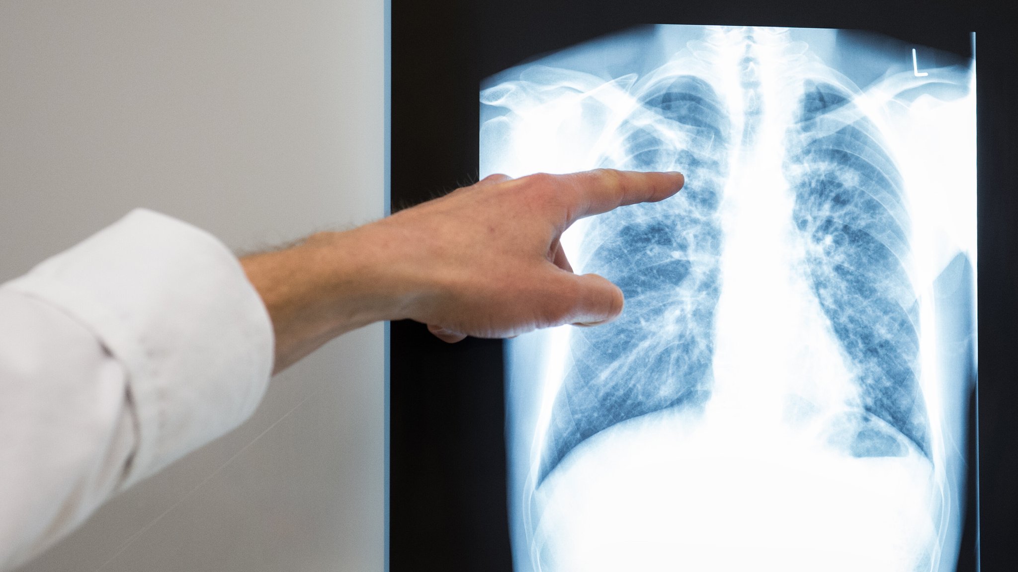 Ein Arzt zeigt auf einem Röntgenbild eines Torso die Tuberkulose-Erkrankung. | Bild: picture alliance / Silas Stein/dpa | Silas Stein Ein Arzt zeigt auf einem Röntgenbild eines Torso die Tuberkulose-Erkrankung.