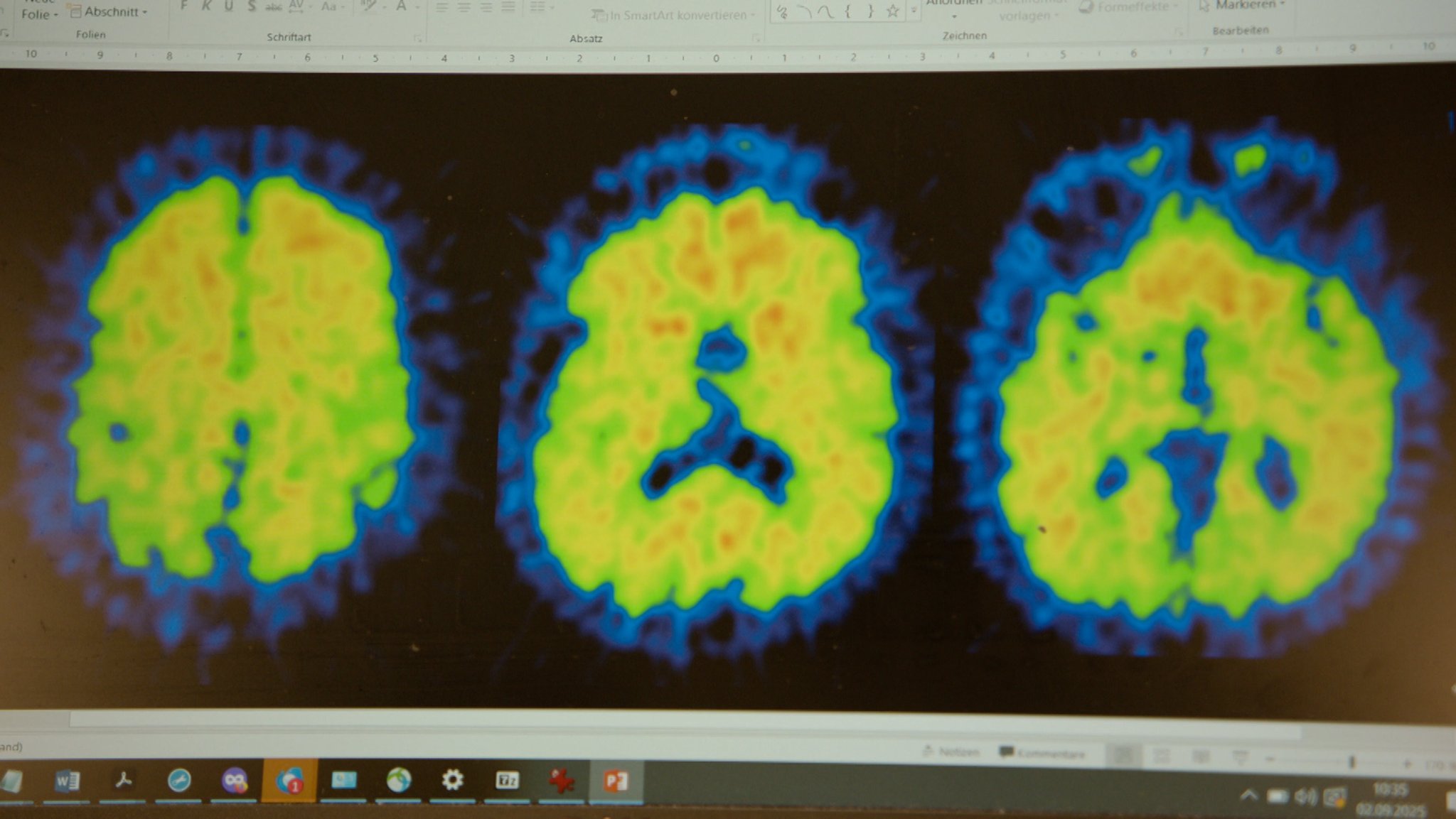 Aufnahmen eines von Alzheimer betroffenen Gehirns.