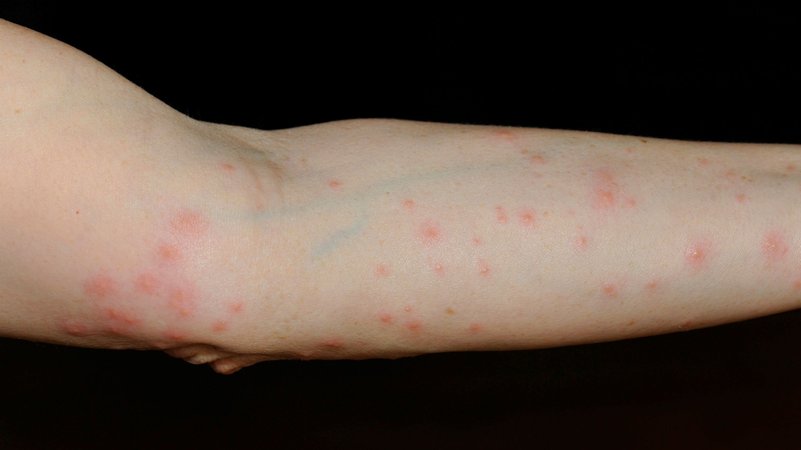 Pilze, Verbenen,
Ausschlag verursacht durch Grasmilbe
| Bild: Picture alliance/dpa Pilze, Verbenen,
Ausschlag verursacht durch Grasmilbe