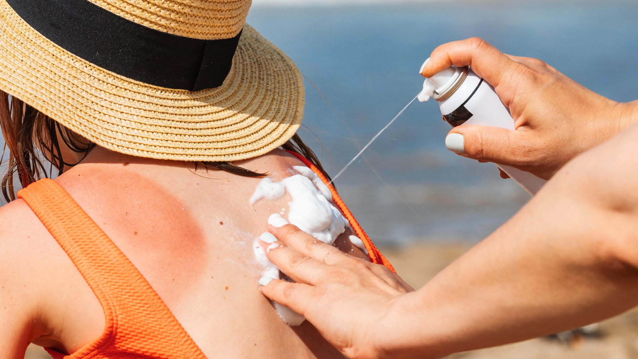 (Symbolbild) Frauenhände sprühen Sonnencreme auf den Rücken eines Kindes, auf dem schon ein Sonnenbrand zu erkennen ist.