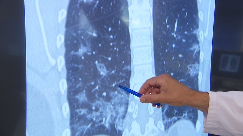 Es mehren sich die Anzeichen, dass eine Covid-19-Erkrankung nicht einfach wieder geht. Patienten berichten von lang anhaltenden Lungenproblemen.