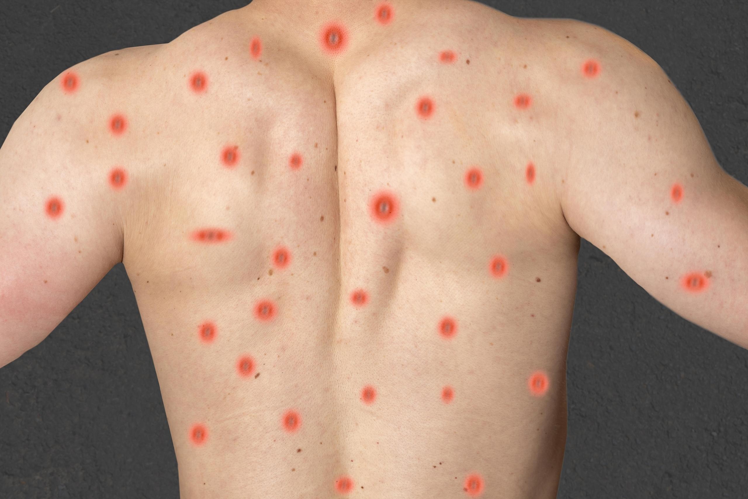 Fotomontage von Affenpocken beziehungsweise Mpox auf dem Rücken eines jungen Mannes