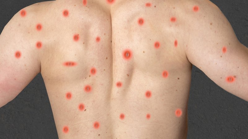Fotomontage von Affenpocken beziehungsweise Mpox auf dem Rücken eines jungen Mannes | Bild: picture alliance / CHROMORANGE | Michael Bihlmayer Fotomontage von Affenpocken beziehungsweise Mpox auf dem Rücken eines jungen Mannes
