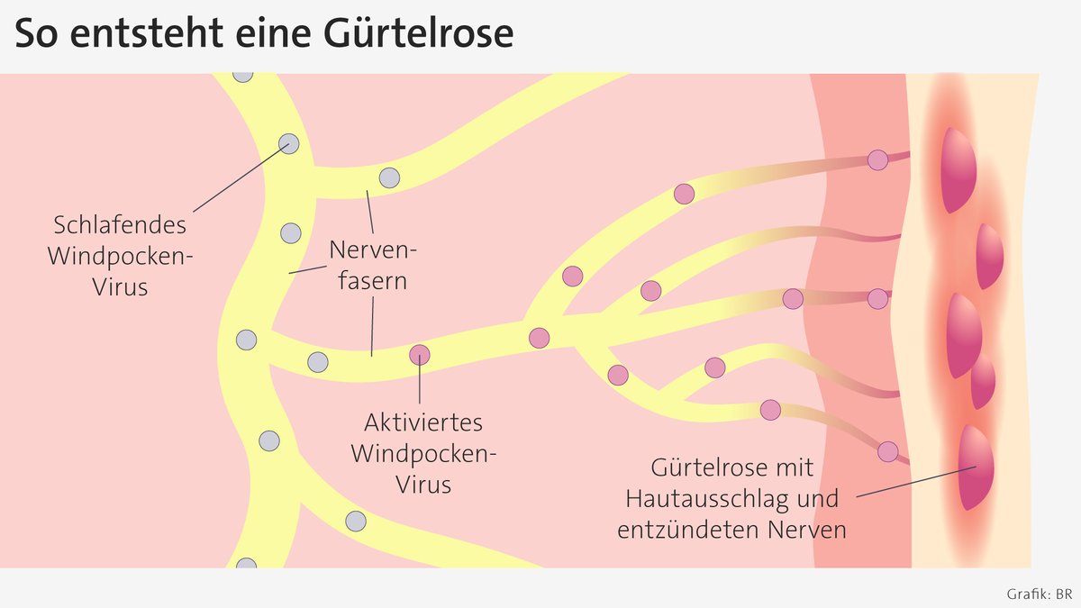 Grafische Darstellung, wie die Windpockenviren wieder reaktiviert werden | Bild: Grafik: BR Grafische Darstellung, wie die Windpockenviren wieder reaktiviert werden