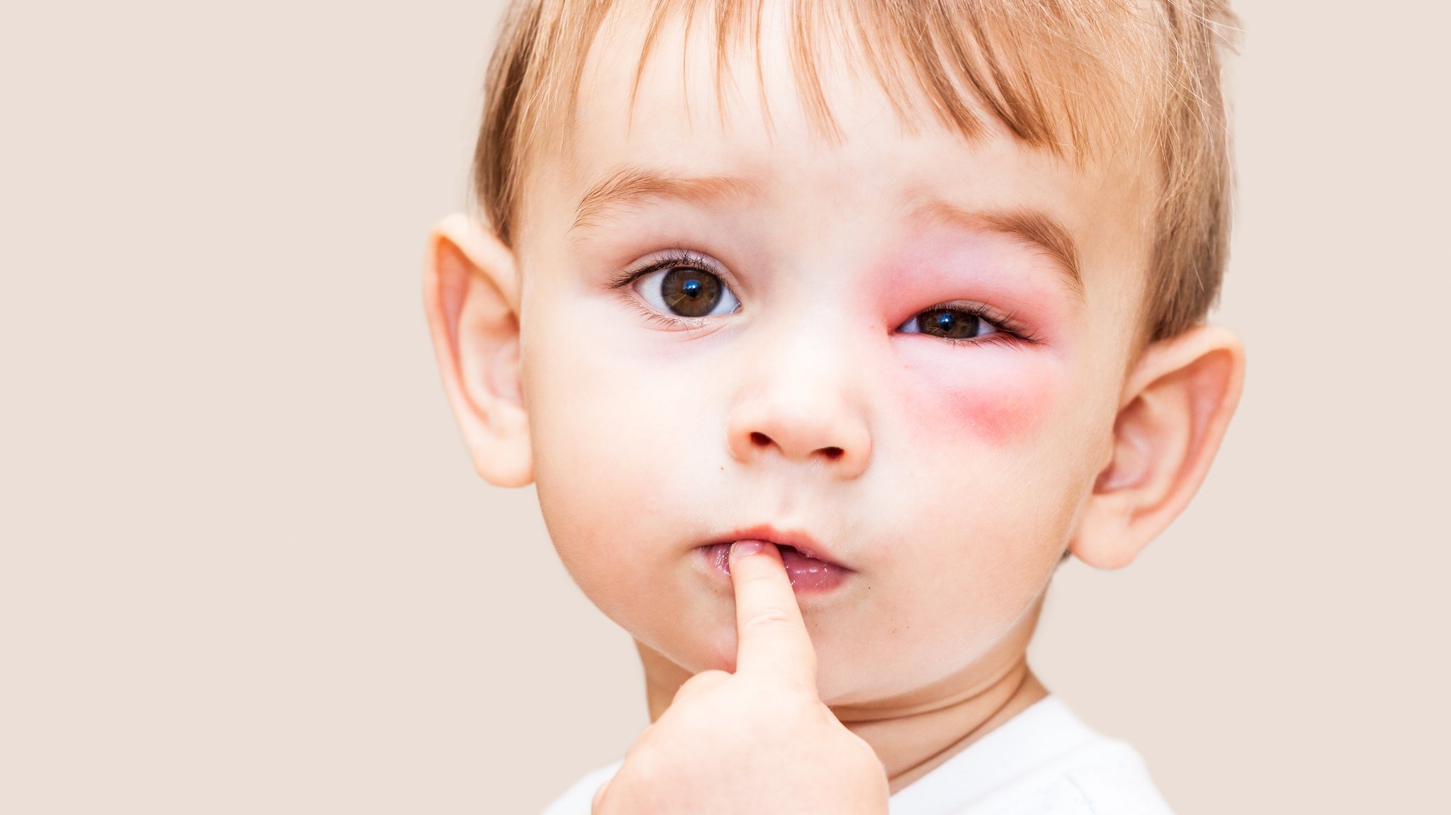 Kleiner Junge mit geschwollenem Auge nach einen Wespenstich
