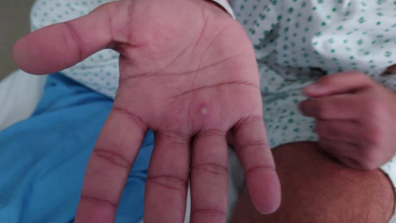 Affenpocken-Symptome auf einer Hand