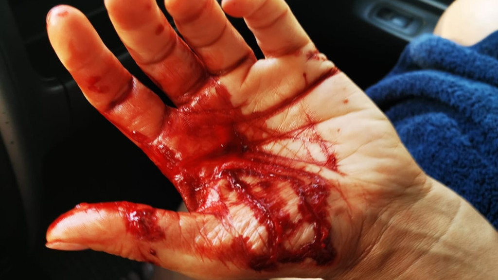 Eine blutende Hand nach einem Hecht-Angriff.