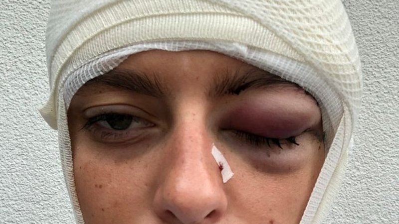 Gesicht einer schwer verletzten jungen Frau mit Verband um den Kopf.