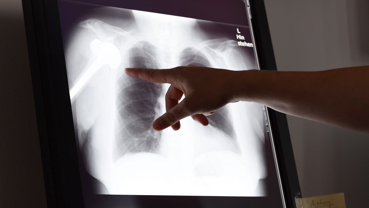 Eine Hand zeigt in der Schlichtungsstelle für Arzthaftpflichtfragen der norddeutschen Ärztekammern auf ein Röntgenbild.