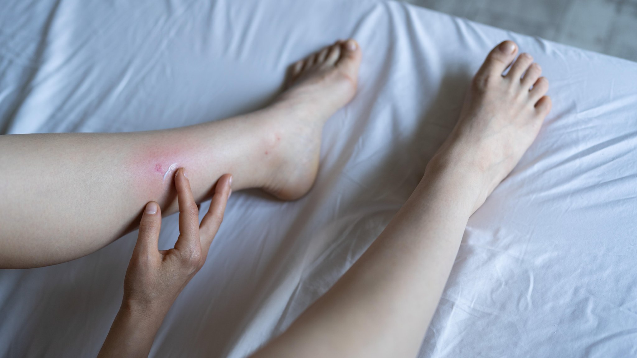 Ein Mädchen sitzt zu Hause auf dem Bett und cremt die geschwollene Haut an ihrem Bein ein, die durch Mücken- oder Stechmückenstiche entstanden ist. | Bild: picture alliance / Zoonar | Dmitrii Marchenko / Envato Ein Mädchen sitzt zu Hause auf dem Bett und cremt die geschwollene Haut an ihrem Bein ein, die durch Mücken- oder Stechmückenstiche entstanden ist.