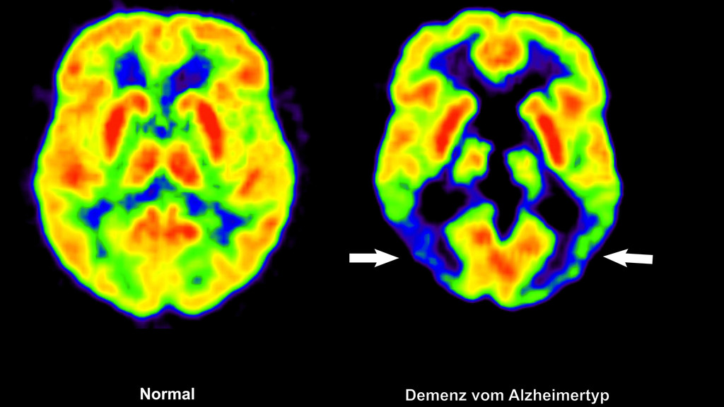 Gegenüberstellung zweier Gehirne mithilfe einer Positronen-Emissions-Tomografie (PET): links im gesunden Zustand, rechts mit Alzheimer. US-Forscher haben jetzt ein Programm entwickelt, mit dem Anzeichen von Alzheimer früher erkannt werden können als bisher.
