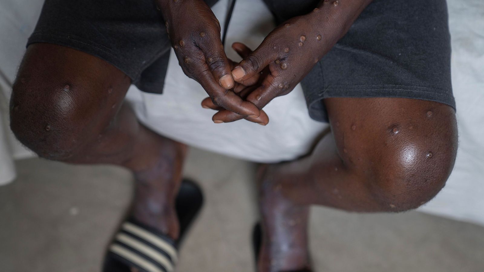 Image accompanying Der jüngste Mpox-Ausbruch wurde durch die Corona-Impfung ausgelöst.