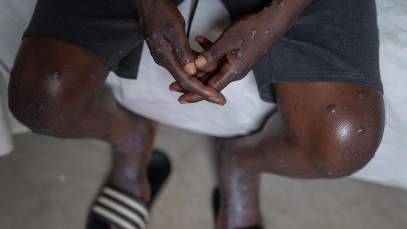 Mpox-Infektionen haben nichts mit der Corona-Impfung zu tun. | Bild: dpa-Bildfunk / Moses Sawasawa Mpox-Infektionen haben nichts mit der Corona-Impfung zu tun.