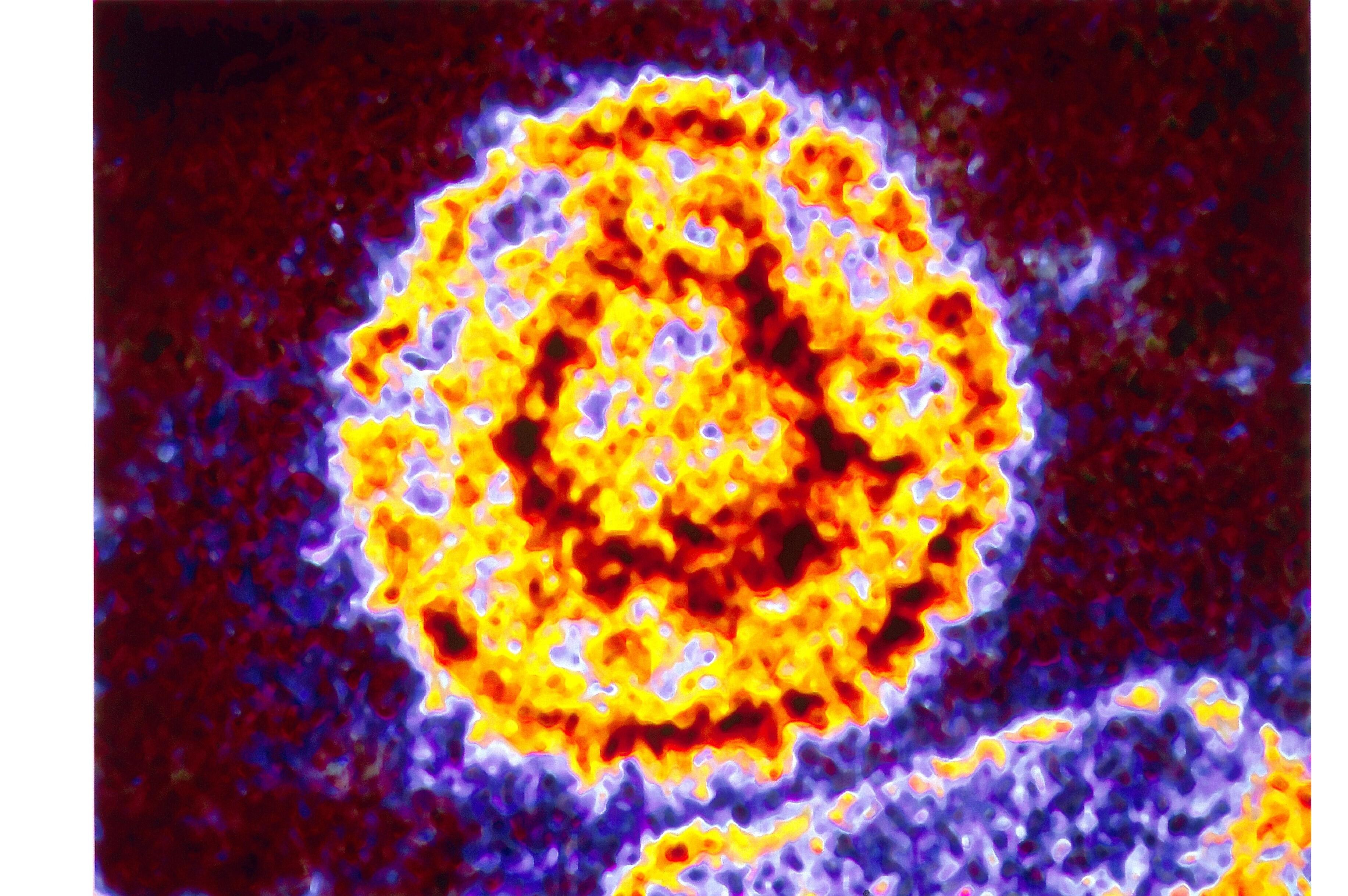 Мононуклеоз вирус эпштейна. Вирус Эпштейна-Барр сыпь. Вирус Эпштейна-Барр фото вируса.