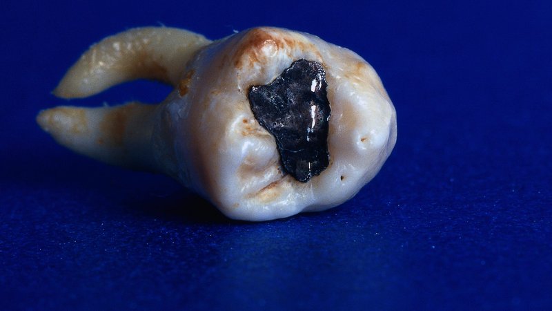 Ein Zahn mit einer quecksilberhaltigen Amalgan-Füllung