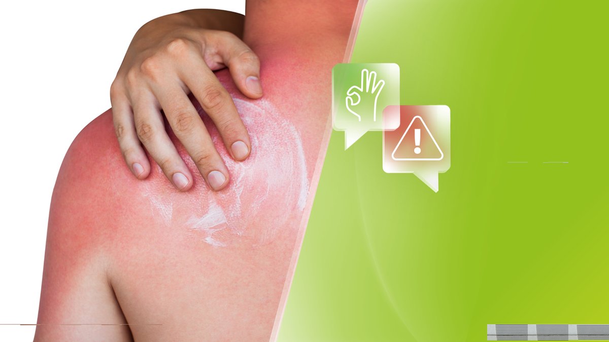 Hilft eine After Sun-Creme wirklich bei einem Sonnenbrand?