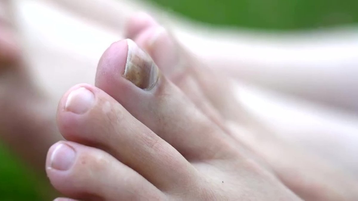 Fußpflege, Podologie: Tipps gegen Hornhaut, Hühneraugen und eingewachsene Zehennägel