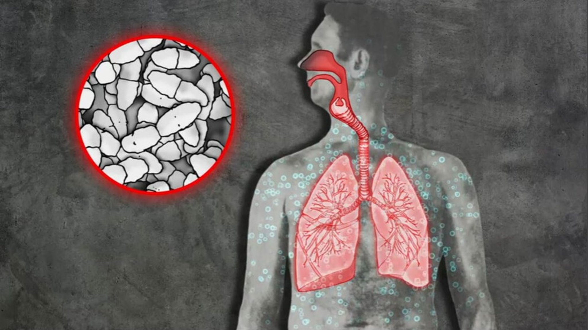 Erkältung und Lungenentzündung: Pneumokokken-Impfung kann Leben retten