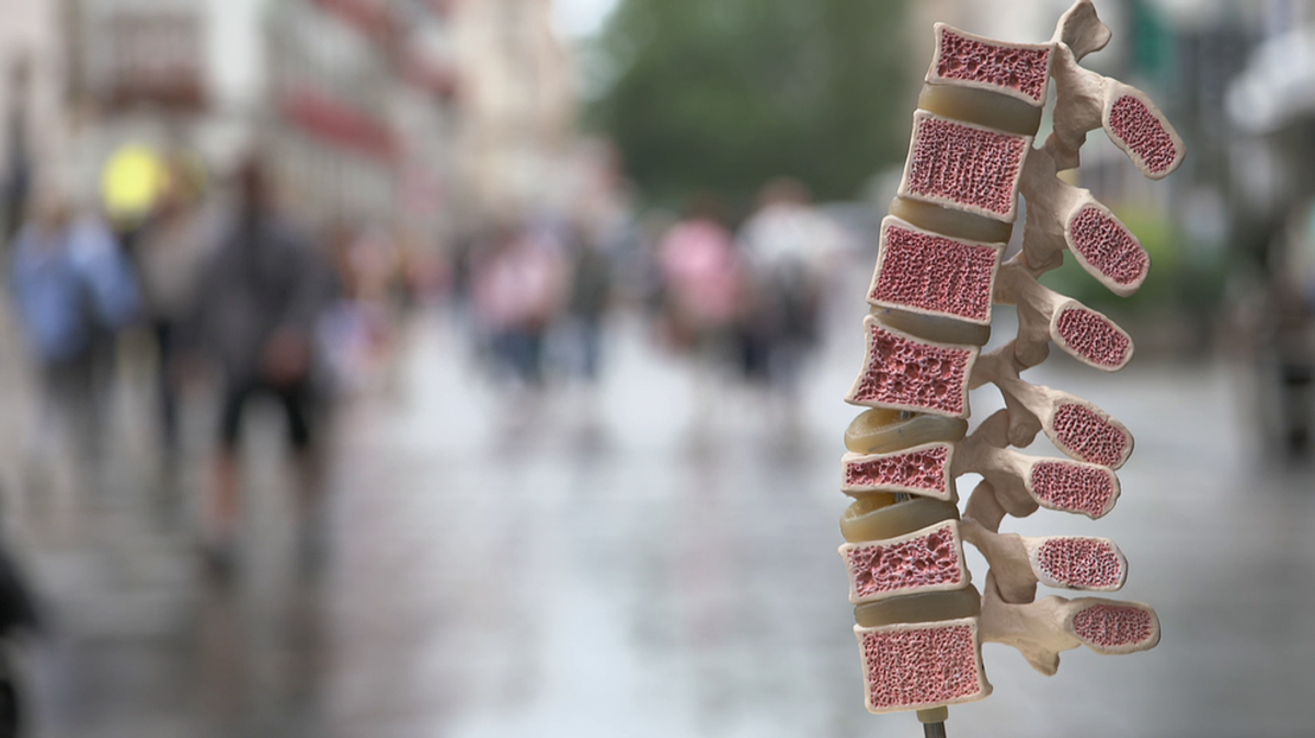 Knochenabbau: Was tun gegen Osteoporose?