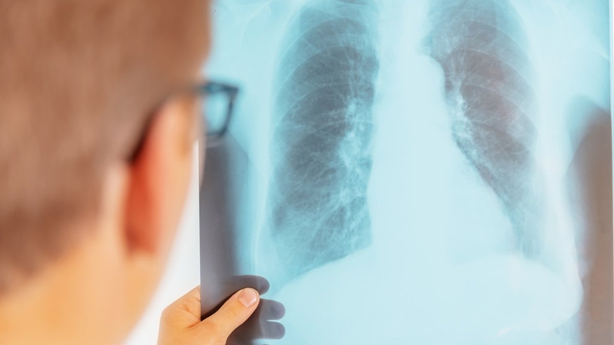 Tuberkulose:  Wie groß ist die Ansteckungsgefahr?