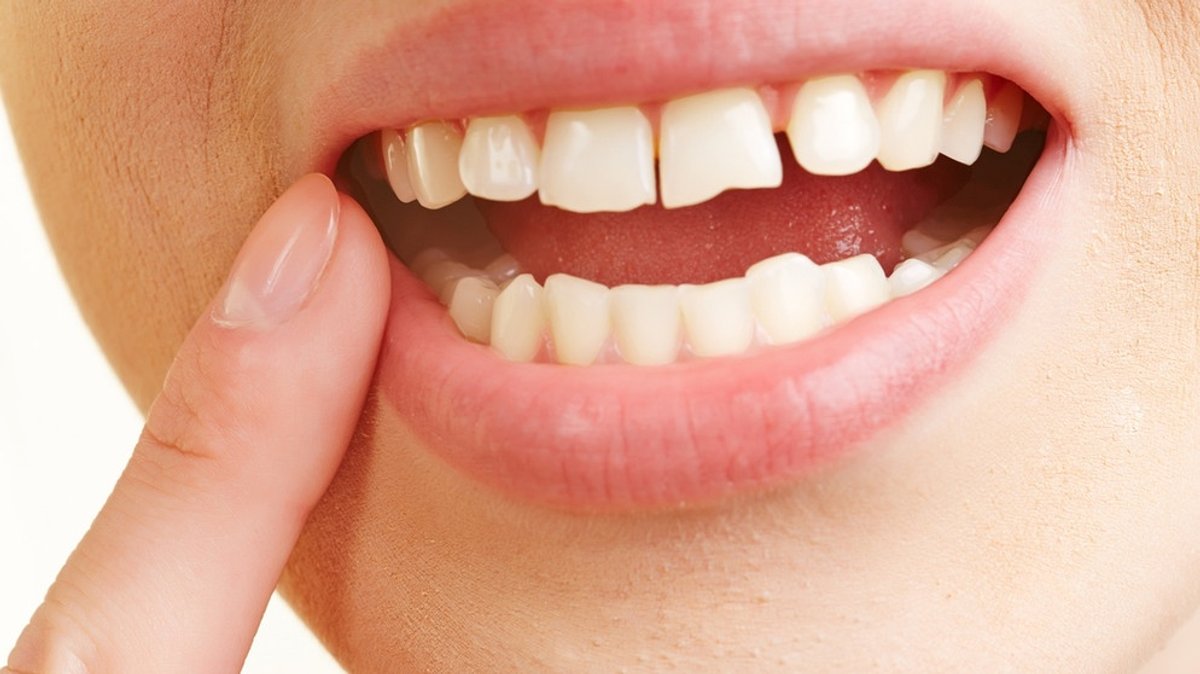 Zahnmedizin: Zahnfleischentzündung vorbeugen und behandeln